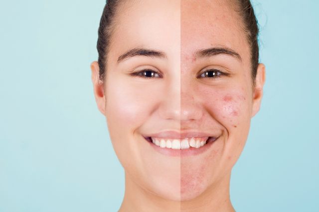Acné Clínica Dermapiel en Xela Quetzaltenango