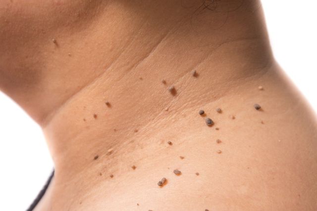 Acrocordones Clínica Dermapiel en Xela Quetzaltenango