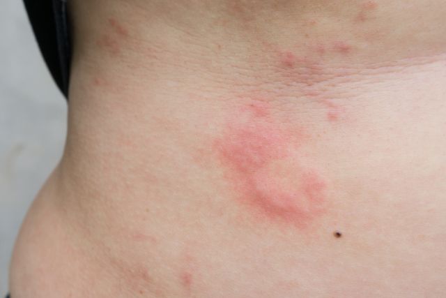 Alergias Clínica Dermapiel en Xela Quetzaltenango 1