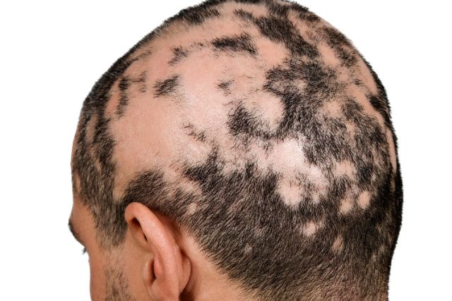 Alopecia Clínica Dermapiel en Xela Quetzaltenango