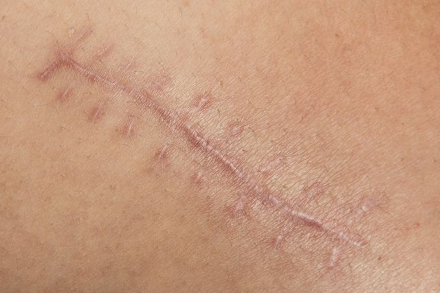 Cicatrices Clínica Dermapiel en Xela Quetzaltenango