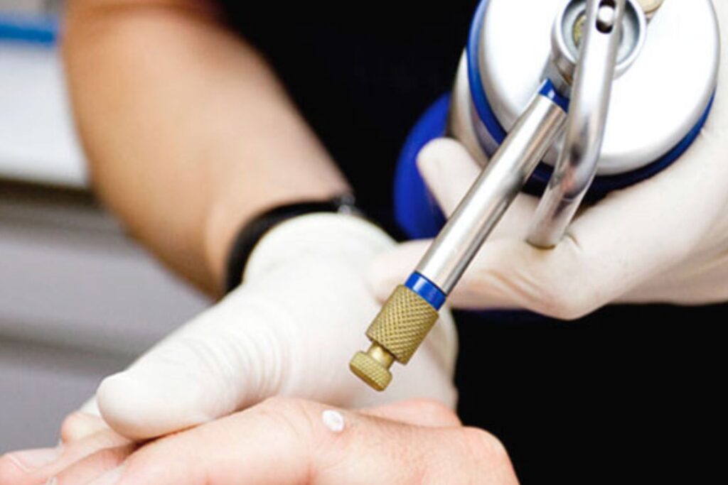 Crioterapia en Dermapiel Xela Quetzaltenango