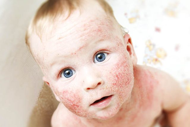 Dermatitis atópica Clínica Dermapiel en Xela Quetzaltenango