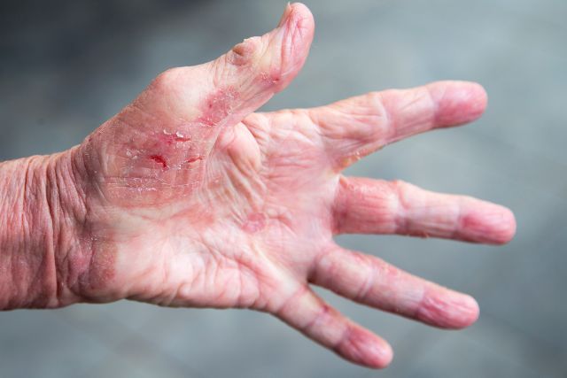 Dermatitis por contacto Clínica Dermapiel en Xela Quetzaltenango