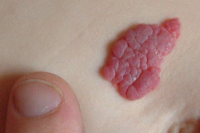 Hemangiomas Clínica Dermapiel en Xela Quetzaltenango