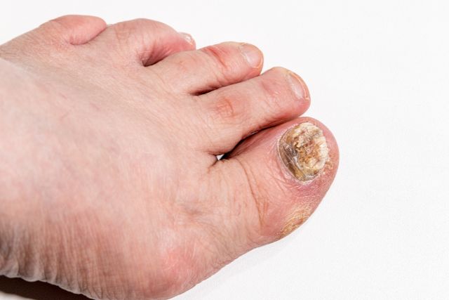 Hongos en la uña Clínica Dermapiel en Xela Quetzaltenango