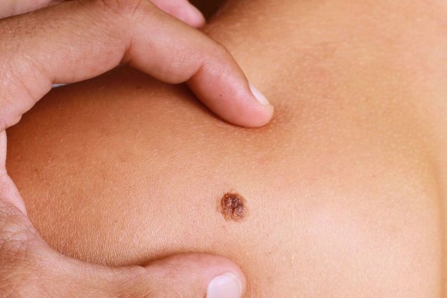 Lunares Clínica Dermapiel en Xela Quetzaltenango
