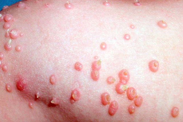 Moluscos Clínica Dermapiel en Xela Quetzaltenango