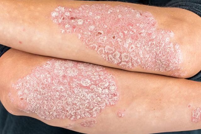Psoriasis Clínica Dermapiel en Xela Quetzaltenango