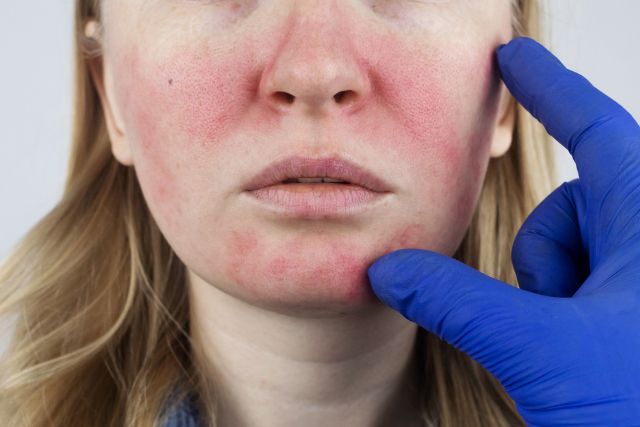 Rosácea Clínica Dermapiel en Xela Quetzaltenango 1