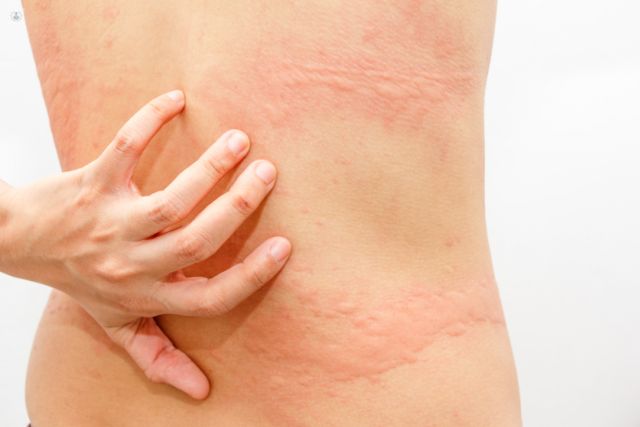 Urticaria Clínica Dermapiel en Xela Quetzaltenango 1