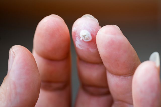 Verrugas Clínica Clínica Dermapiel en Xela Quetzaltenango 1